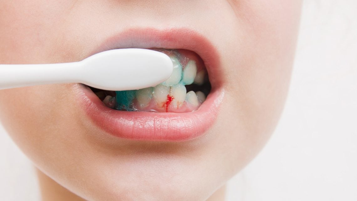 Zahnfleischbluten – was hilft?
