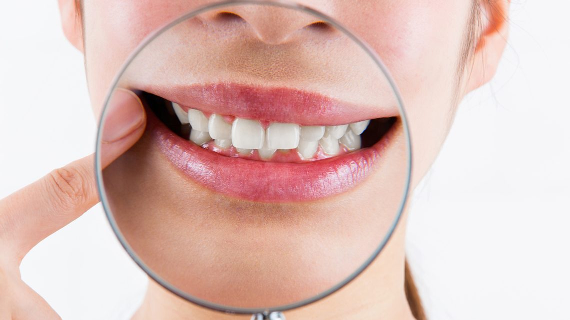 Zahnfleischentzündung – was ist das?